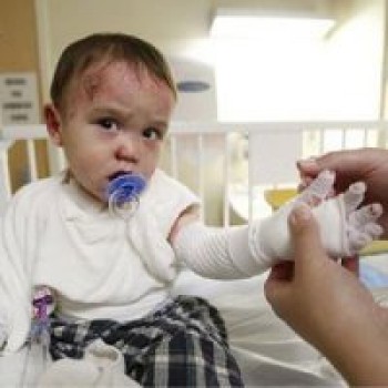 ۴ هزار و ۵۰۰ نفر درگیر بیماری ای بی/ هزینه ماهیانه پماد و پانسمان؛ ۷۵۰ هزار تومان 