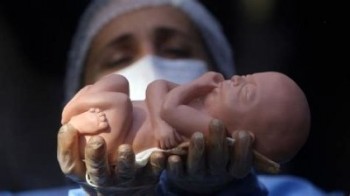 ۳ درصد از آمار سقط‌ جنین در ایران ناشی از روابط نامشروع است