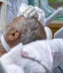 ۳۴۲۰ نفر از مبتلایان به کرونا تحت مراقبت قرار دارند